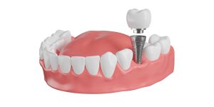 Dental Implants