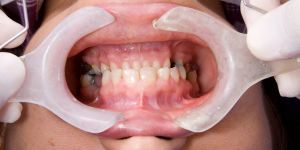 Full Mouth Rehabilitation
