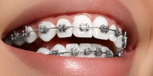 Orthodontic Treatment